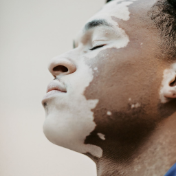 Peut-on soigner un vitiligo ?